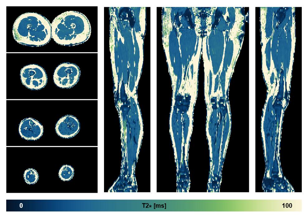The T2 star relaxation time of the lower extremity obtained from the dixon reconstruction for muscle water fat quantification.